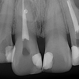 #11- External root resorption due to presence of the lateral canal