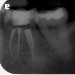 Single-cone-technique-#36